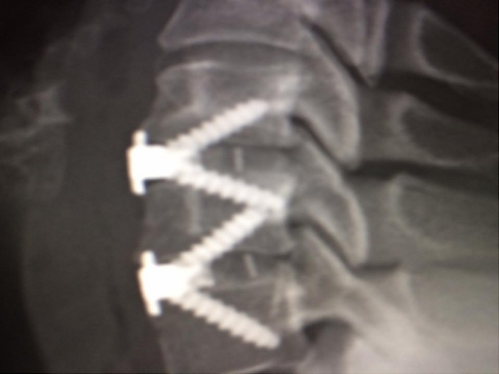 Operacja kręgosłupa szyjnego z zastosowaniem nowoczesnych implantów