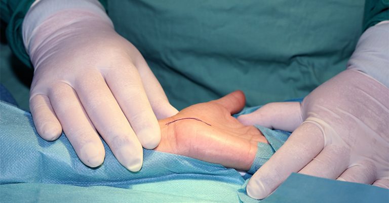 operacja mini open