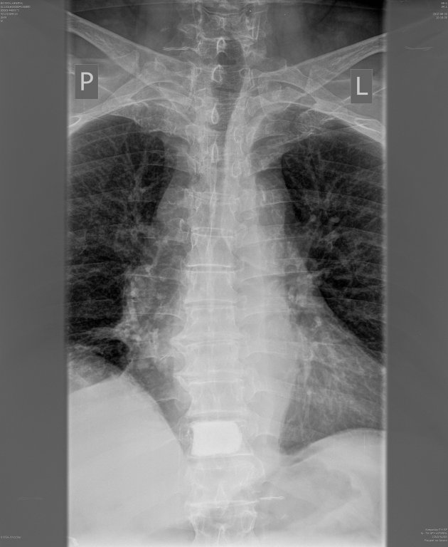 wertebroplastyka_th10.jpg