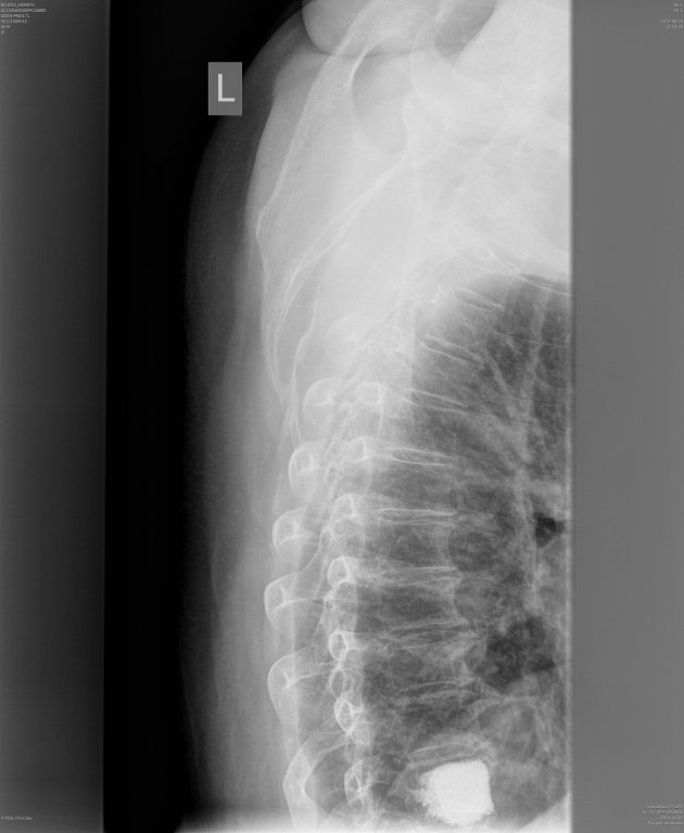 wertebroplastyka_th10.jpg